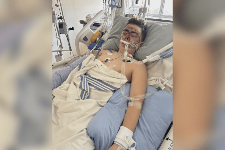 Adolescente de Okanagan Falls gravemente ferido em acidente de esqui no Apex Mountain Resort