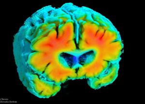 Alzheimer pode começar com uma queda silenciosa no fluxo sanguíneo cerebral