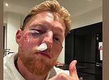 Ben Stokes sofre um revés no caminho para retornar de uma terrível lesão facial enquanto o cirurgião dá más notícias antes da temporada do County Championship