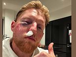 Ben Stokes sofre um revés no caminho para retornar de uma terrível lesão facial enquanto o cirurgião dá más notícias antes da temporada do County Championship