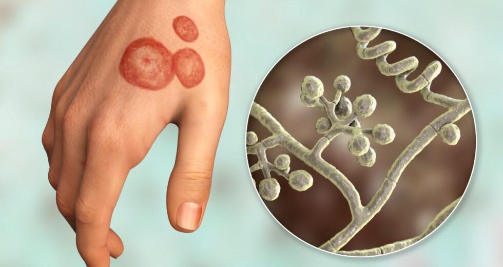 A micose é comum em academias e barbearias do Reino Unido – mas muitos não a percebem