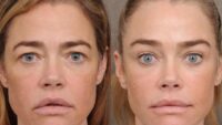 Denise Richards revelou seu facelift e não é uma vitória para a transparência