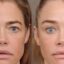 Denise Richards revelou seu facelift e não é uma vitória para a transparência