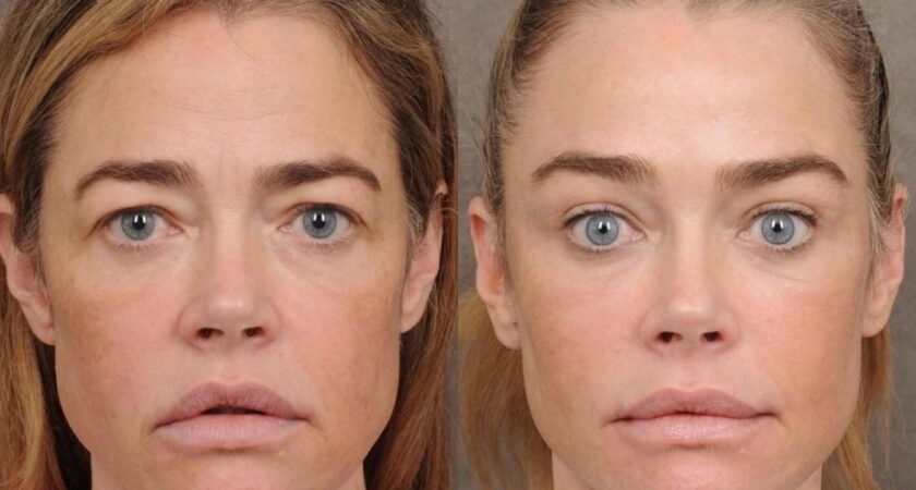 Denise Richards revelou seu facelift e não é uma vitória para a transparência
