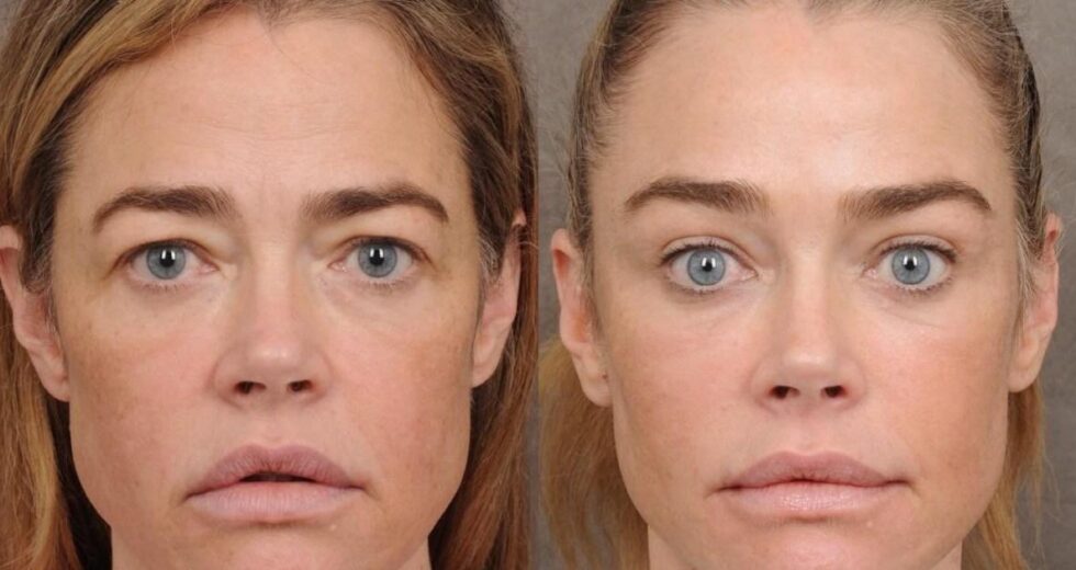 Denise Richards revelou seu facelift e não é uma vitória para a transparência