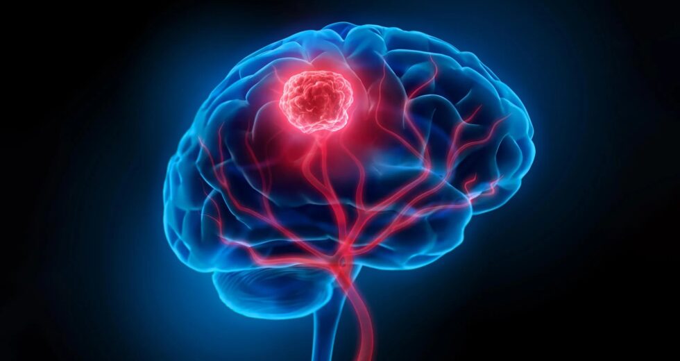 Esta terapia viral sobrecarrega o sistema imunológico contra o câncer no cérebro