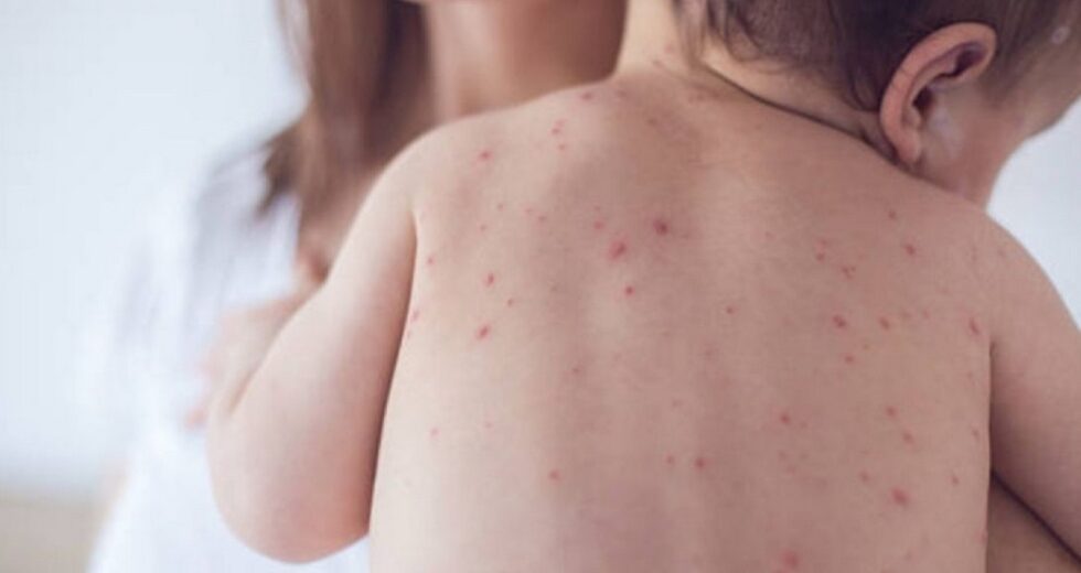 Dois casos de sarampo encontrados em Prambanan Klaten, vacinação preparada