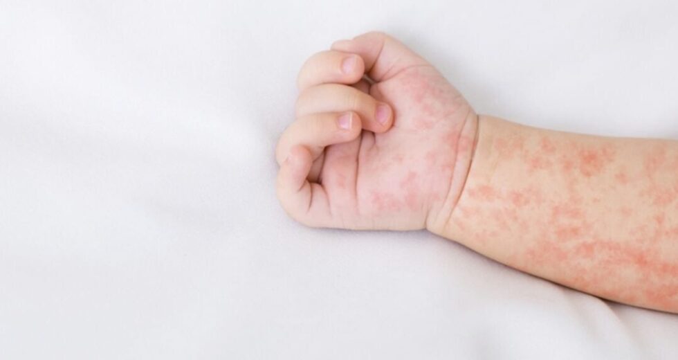 O sarampo surge antes do regresso a casa, os que regressam a casa são solicitados a estarem alertas