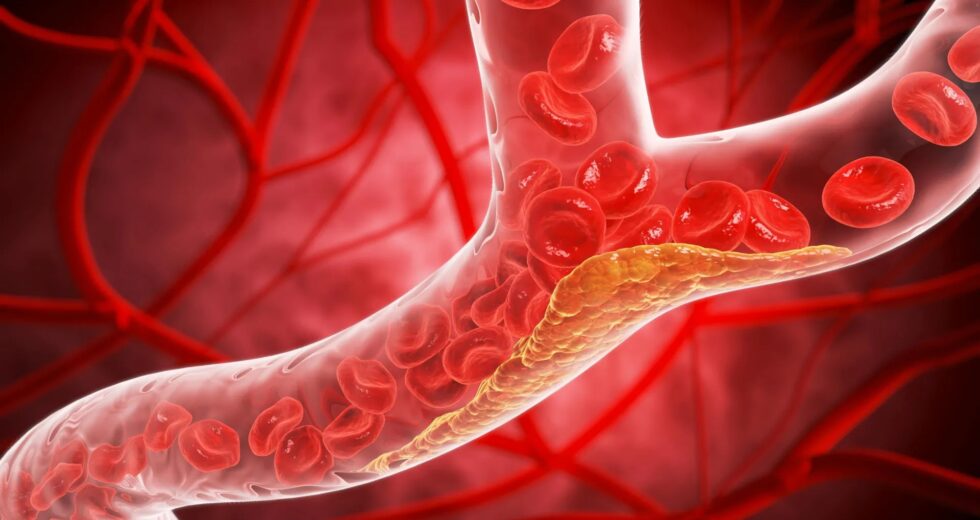 Nova pílula reduz o colesterol “ruim” em 60% em grande ensaio