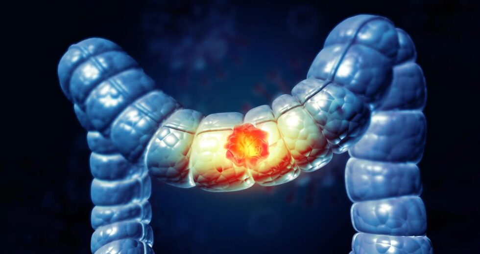 A maioria dos americanos não sabe que este alimento aumenta o risco de câncer de cólon