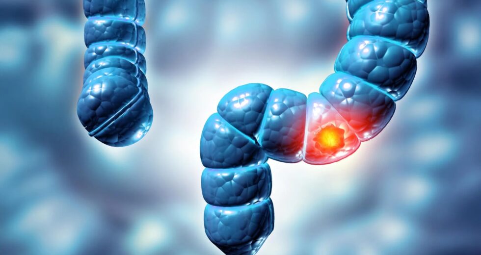 Estudo descobre que dois tipos de pólipos de cólon podem aumentar em cinco vezes o risco de câncer de intestino