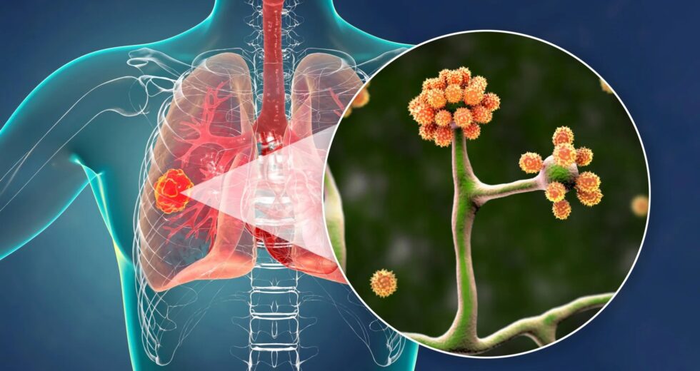 Esta simples proteína do sangue pode impedir um fungo negro mortal