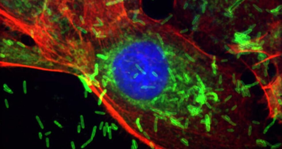 Bactéria da doença gengival associada ao crescimento e disseminação do câncer de mama