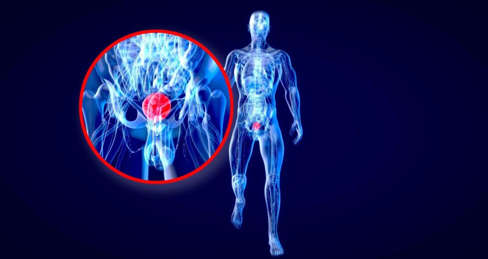 Cientistas de Stanford dizem que o daltonismo pode esconder um alerta mortal sobre câncer de bexiga