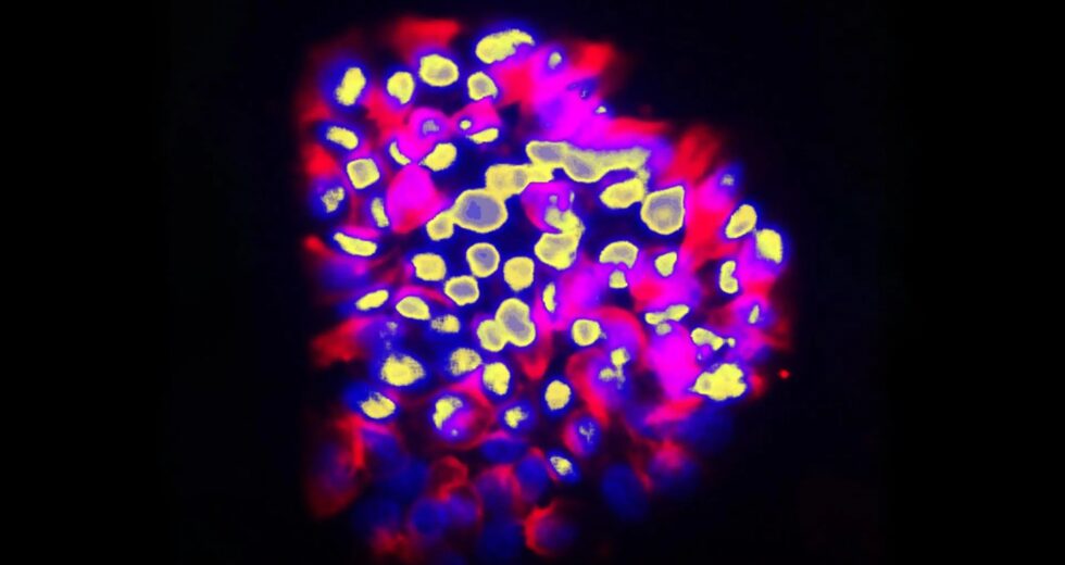 Nova ferramenta de IA prevê propagação do câncer com precisão surpreendente