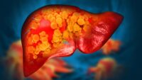 Clínica Mayo descobre mutação genética rara que causa doença hepática gordurosa