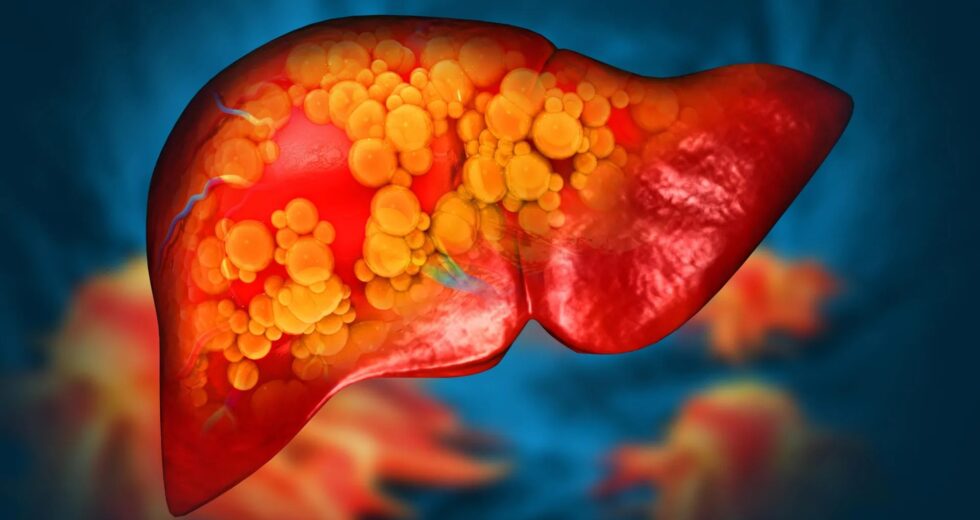 Clínica Mayo descobre mutação genética rara que causa doença hepática gordurosa