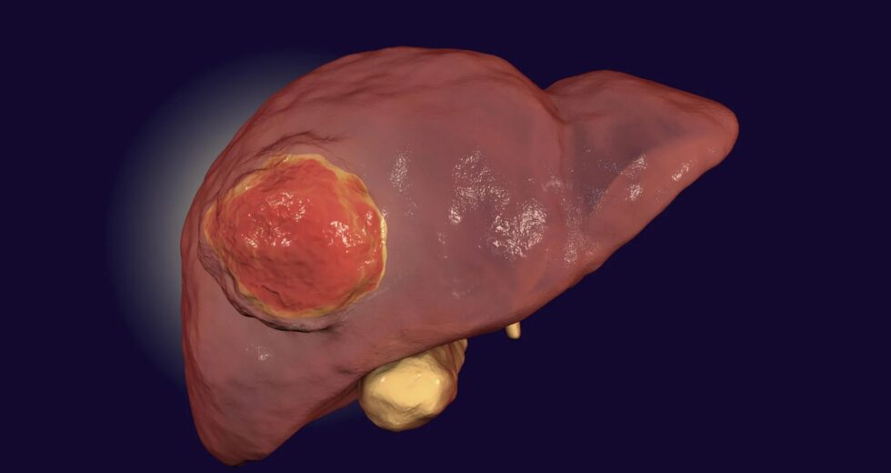 Comer menos proteína pode retardar o crescimento do câncer de fígado, segundo estudo