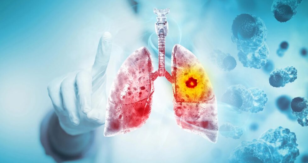 Cientistas descobrem por que esse câncer de pulmão mortal continua voltando