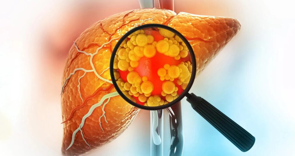 Um tratamento promissor para o fígado gorduroso pode aumentar o risco de câncer