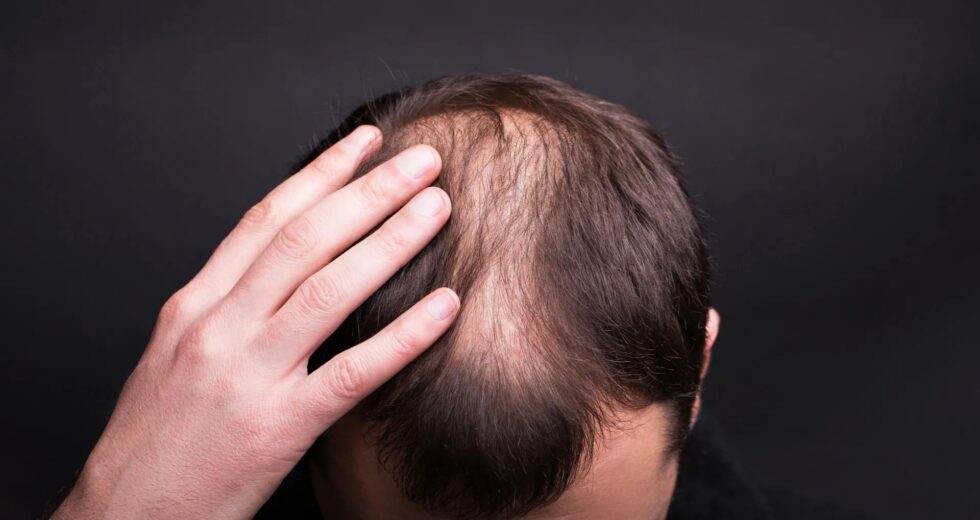 Os livros didáticos estavam errados: os cientistas revelam a forma surpreendente como o cabelo humano realmente cresce