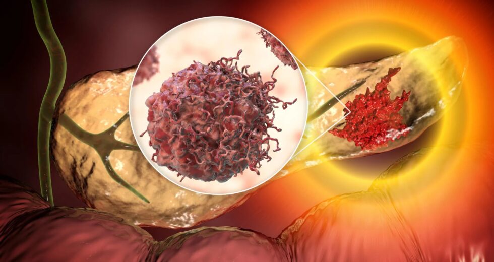Novo exame de sangue pode detectar câncer de pâncreas antes que seja tarde demais