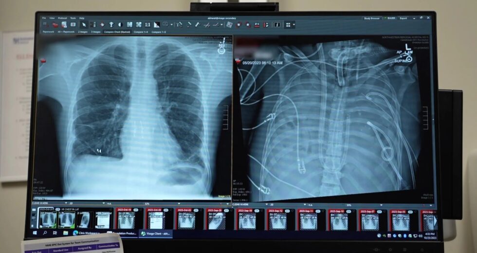 Ele sobreviveu 48 horas sem pulmões e viveu