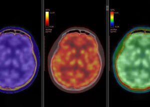Exames cerebrais revelam como a cetamina elimina rapidamente a depressão grave