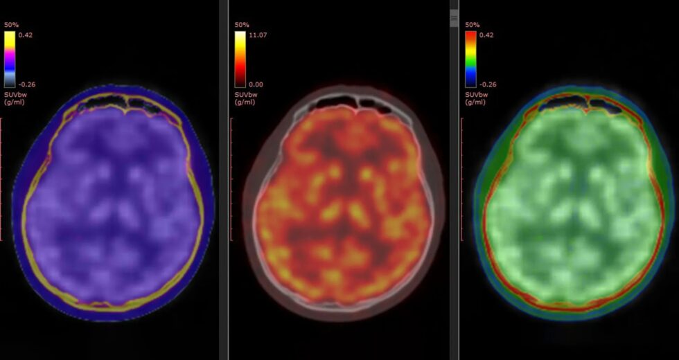 Exames cerebrais revelam como a cetamina elimina rapidamente a depressão grave