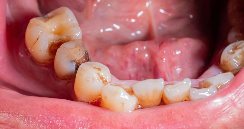 Corrigir uma infecção dentária pode melhorar o açúcar no sangue e a saúde do coração