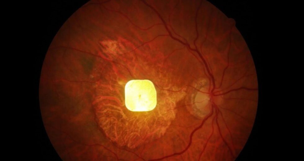 Implante de retina sem fio ajuda pacientes cegos a enxergar novamente