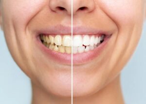 Este novo pó dental branqueia os dentes sem danificá-los