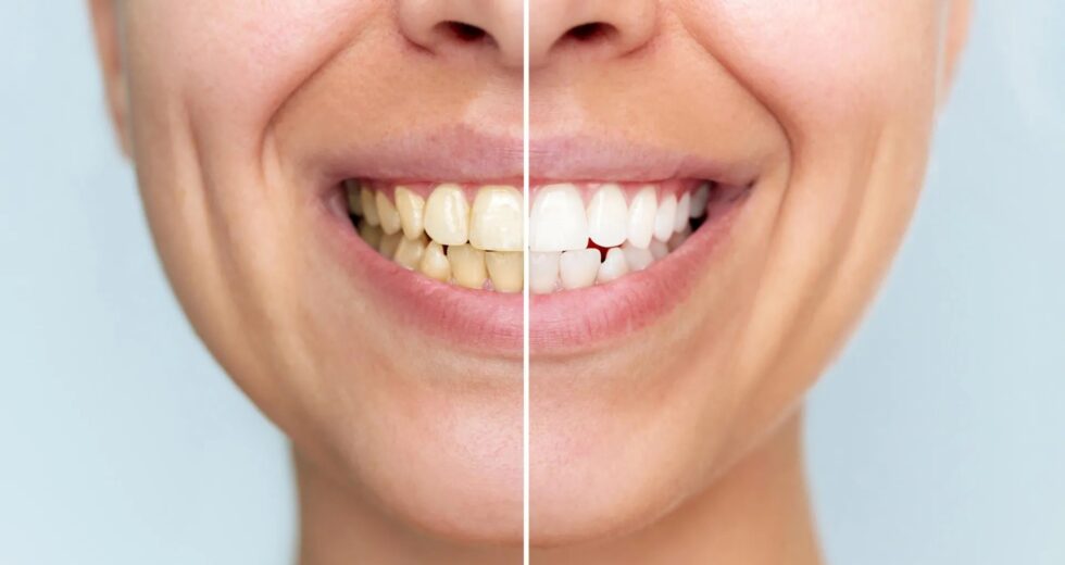 Este novo pó dental branqueia os dentes sem danificá-los